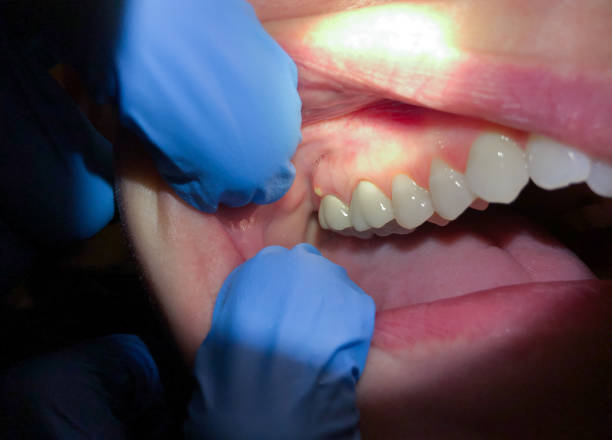 Best Emergency Root Canal Treatment in Rutherfordton, NC